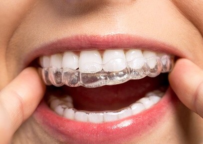 Invisalign and clear aligners - Tarneit Dental Care