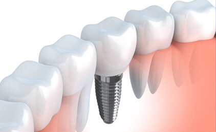 Dental Implants Treatment - Tarneit Dental Care
