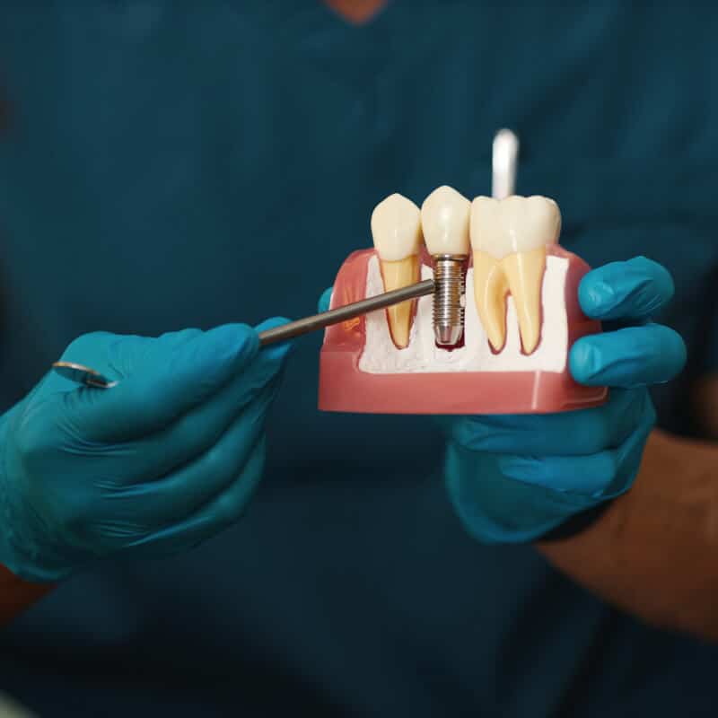  Dental Implants