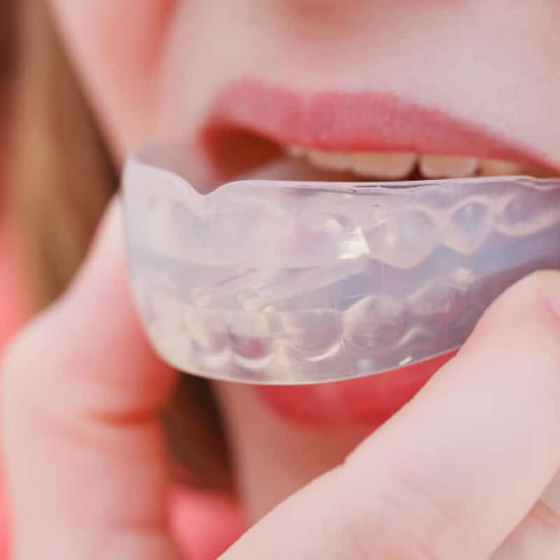 Mouthguards And Splints